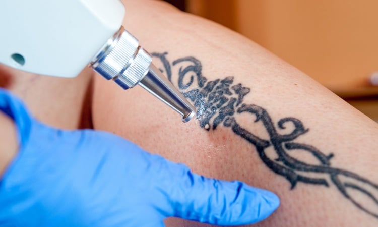 Laser Tattoo Removal Ottawa