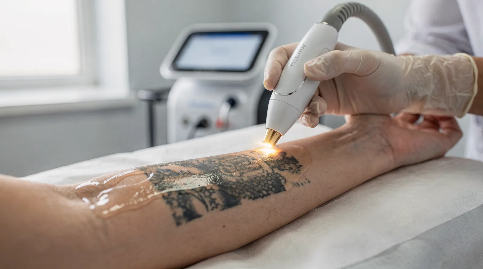 PicoWay delivers very short pulses of energy that target tattoo ink beneath the skin's surface